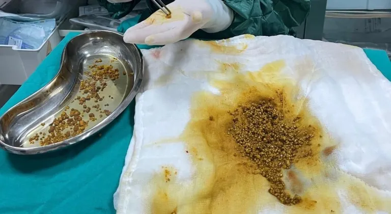 Bingöl’de vatandaşın safra kesesinden 2 bin 67 taş çıkarıldı
