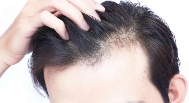 D vitamini eksikliği saç dökülmesine mi neden olur?