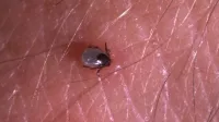 Kene ısırığı hafife alınmamalı