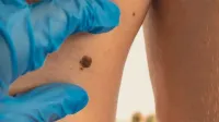 Yaz geliyor, cilt kanserinden korunmak için ne yapmalı?